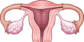 Endometriosi: gli esami per scoprirla e le cure più indicate