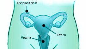 Endometriosi: può essere un ostacolo alla gravidanza