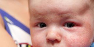 Boom di dermatite atopica tra i bambini: i consigli dei pediatri