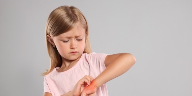 Reazione allergica alle punture di insetti: cosa fare