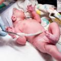 Acidi grassi nel cordone ombelicale responsabili delle allergie nei bambini?