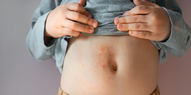 Scabbia nei bambini: come si trasmette, sintomi e cure