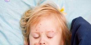 Morbillo: casi in netto aumento nel 2014