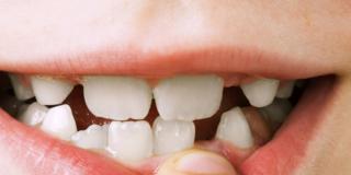 Salute: sempre più numerosi i bambini con problemi ai denti