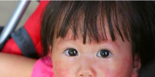 Psoriasi: nuove cure per i bambini