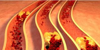 Colesterolo: due italiani su 3 non lo controllano