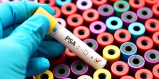 Cancro alla prostata: un nuovo test lo scopre nel sangue