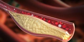Colesterolo cattivo: livelli più restrittivi