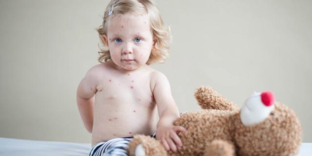 Varicella e herpes zoster possono provocare l’ictus