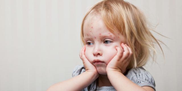 Morbillo: mortalità in crescita