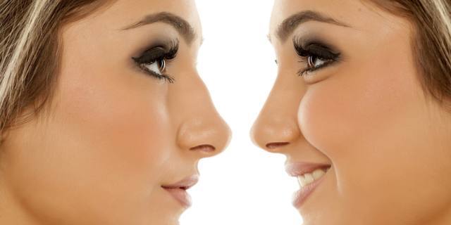 Rinoplastica, numeri in calo