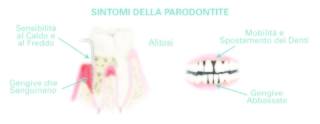 IMI-EDN-sintomi-malattia-parodontale