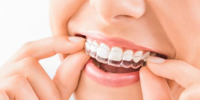 Apparecchio ai denti anche per gli adulti, sì ma solo se…