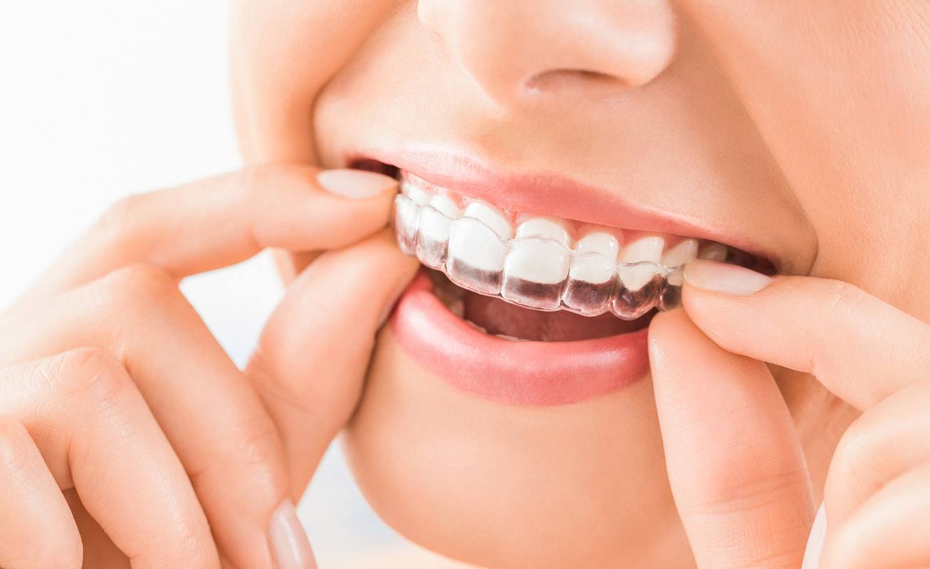 Bambini con l'apparecchio ai denti? Ecco qualche consiglio per i