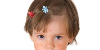 Morbillo: 4,5 milioni di bambini in Europa non sono vaccinati