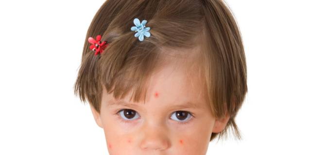 Morbillo: 4,5 milioni di bambini in Europa non sono vaccinati