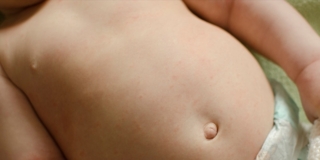 Sesta malattia nei bambini: contagio, sintomi e cure