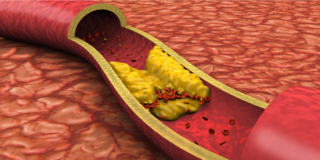 Colesterolo “cattivo”: i valori da non superare per scongiurare infarto e ictus
