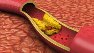 Colesterolo “cattivo”: i valori da non superare per scongiurare infarto e ictus