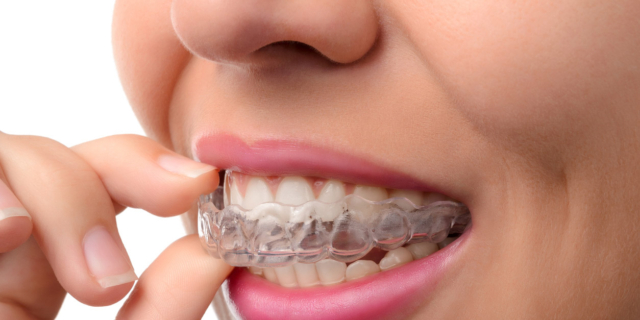 Apparecchi ai denti: no al fai da te!