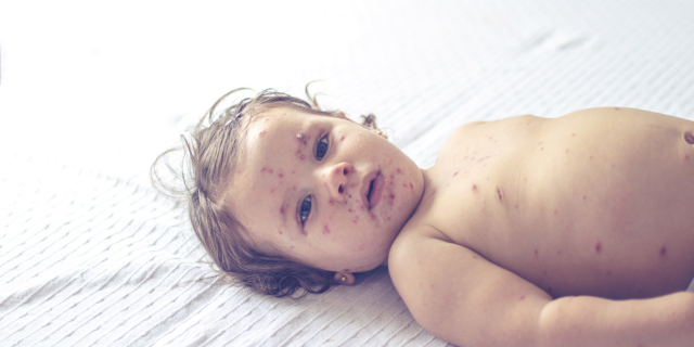 Il morbillo causa una “amnesia immunitaria” che aumenta il rischio di infezioni