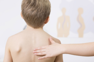 Scoliosi nei bambini, quando è necessario operare?