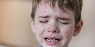 Morbillo: casi in continuo aumento. Allerta resta alta