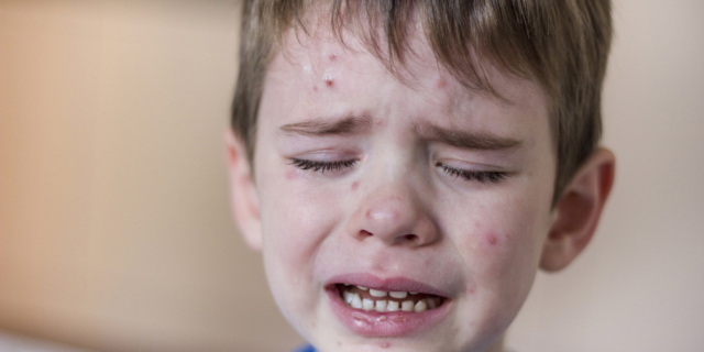 Morbillo: casi in continuo aumento. Allerta resta alta