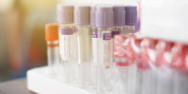 Tumori, in sangue e urine spie per diagnosi precoce e recidive