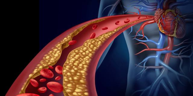 Colesterolo cattivo: c’è un nuovo farmaco per combatterlo