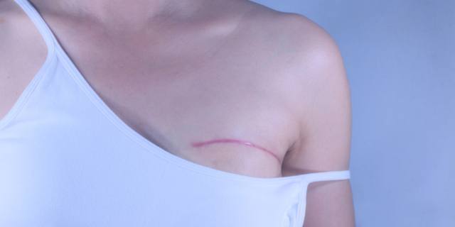 Interventi al seno e Covid, i dubbi delle donne