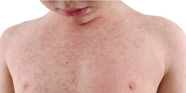Vaccino contro il morbillo in calo per colpa del Covid-19: attenzione ai rischi