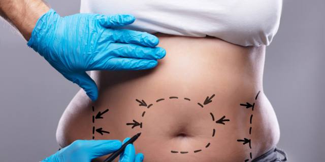 Mini-addominoplastica funziona dopo il parto?