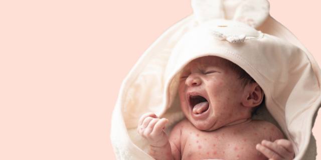 Come riconoscere la sesta malattia nei bambini?