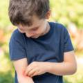 allergie nei bambini anche in estate