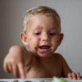 impetigine bambino