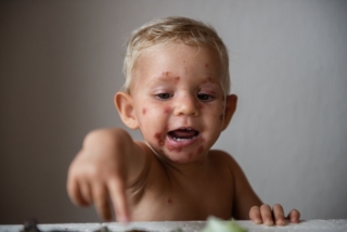 impetigine bambino