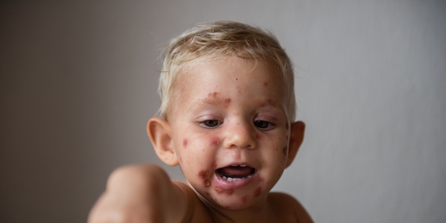 Impetigine nei bambini: cause, sintomi e cure