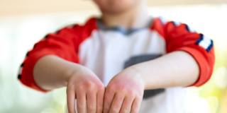 i bambini sono soggetti alla malattia mani-piedi-bocca