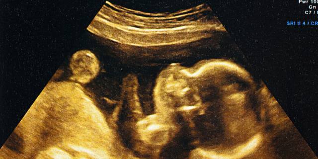 Translucenza nucale: cos’è, quando si fa e valori da valutare