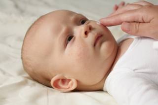 La dermatite atopica compare in genere nel primo anno di vita del bambin