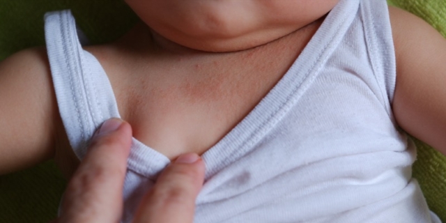 Sudamina o miliaria nei bambini: come riconoscerla e curarla