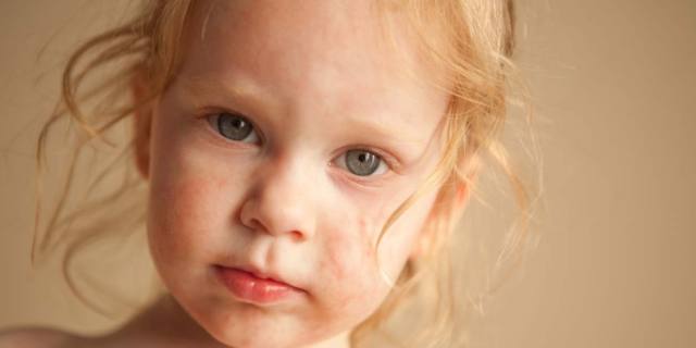 Disturbi della pelle nei bambini dopo l’estate: tutte le varianti dalla pitiriasi alla ricomparsa della dermatite atopica