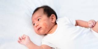 Pitiriasi: sintomi, diagnosi e cura nei bambini