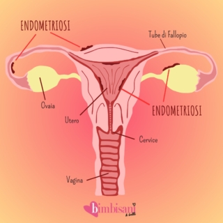 Mestruazioni anticipate dopo l’ablazione dell’endometrio: perché? Mestruazioni anticipate dopo l’ablazione dell’endometrio: perché?