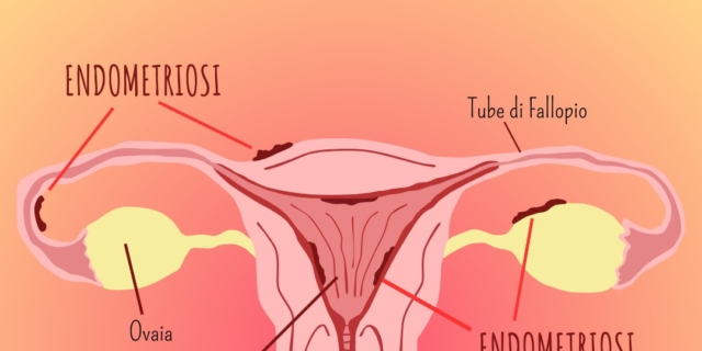 Mestruazioni anticipate dopo l’ablazione dell’endometrio: perché?