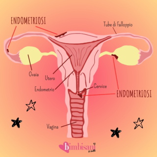 https://www.bimbisaniebelli.it/wp-content/uploads/2024/02/endometriosi-320x320.jpeg