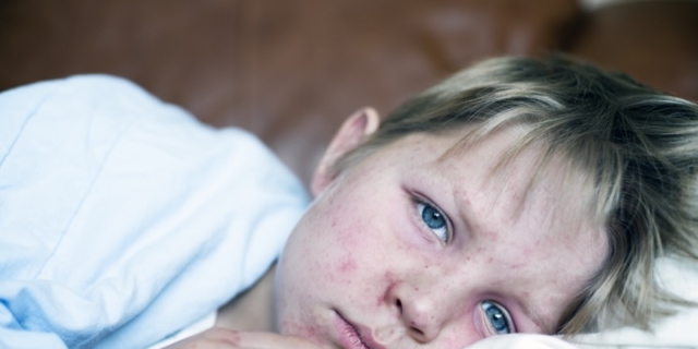 Morbillo in Italia primavera 2024: aumento dei casi per i bambini tra 0 e 4 anni