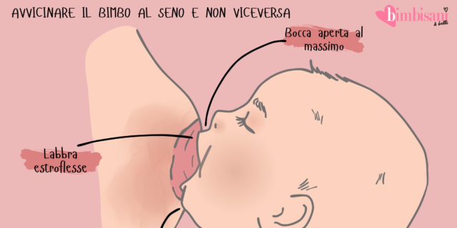 Ragadi al seno in allattamento: come curarle e prevenirle