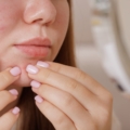 Acne in adolescenza